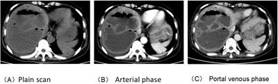 Case report: Brain infarction following percutaneous drainage of a liver abscess post-chemotherapy for pancreatic head cancer